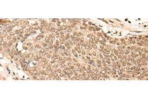 Immunohistochemistry of paraffin-embedded Human esophagus cancer tissue using EIF4A3 Polyclonal Antibody at dilution of 1:45(x200) (EIF4A3 抗体)