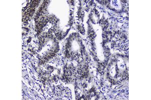 IHC analysis of splicing factor 1 using anti-splicing factor 1 antibody .