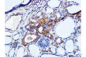 Immunohistochemistry of paraffin-embedded human thyroid cancer using Pan Cadherin Rabbit mAb (ABIN1679719, ABIN3019268, ABIN3019269 and ABIN7101741) at dilution of 1:100 (40x lens). (CDH1,CDH2,CDH3,CDH4 抗体)