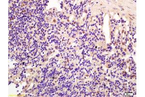 Formalin-fixed and paraffin embedded human gastric carcinoma labeled with Anti-CCDC147 Polyclonal Antibody, Unconjugated  at 1:200 followed by conjugation to the secondary antibody and DAB staining (CCDC147 抗体  (AA 161-260))