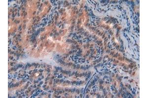DAB staining on IHC-P; Samples: Human Thyroid cancer Tissue (FZD1 抗体  (AA 117-322))