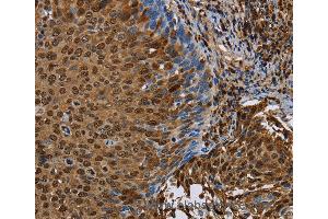 Immunohistochemistry of Human cervical cancer using NRP2 Polyclonal Antibody at dilution of 1:45 (NRP2 抗体)