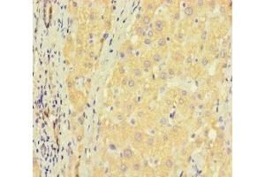 Immunohistochemistry of paraffin-embedded human liver cancer using ABIN7176405 at dilution of 1:100 (ZNF583 抗体  (AA 1-300))