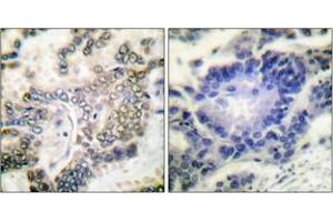 Immunohistochemistry analysis of paraffin-embedded human lung carcinoma tissue, using C/EBP-alpha (Ab-21) Antibody. (CEBPA 抗体  (AA 6-55))