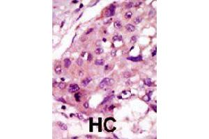 Formalin-fixed and paraffin-embedded human hepatocellular carcinoma tissue reacted with IRAK2 polyclonal antibody  , which was peroxidase-conjugated to the secondary antibody, followed by DAB staining. (IRAK2 抗体  (C-Term))