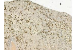 ABIN6265655 and ABIN6277246 at 1/100 staining human melanoma by IHC-P.