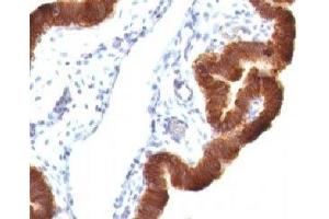 Formalin-fixed, paraffin-embedded human ovarian carcinoma stained with Cytokeratin 19 antibody (KRT19/799 + KRT19/800)