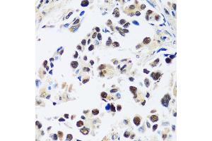 Immunohistochemistry of paraffin-embedded human lung cancer using  antibody (ABIN7265374) at dilution of 1:100 (40x lens). (ASCL4 抗体  (AA 1-172))