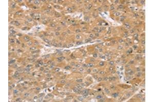 The image on the left is immunohistochemistry of paraffin-embedded Human liver cancer tissue using ABIN7192739(TBC1D21 Antibody) at dilution 1/30, on the right is treated with synthetic peptide. (TBC1D21 抗体)