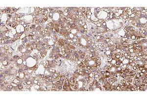 ABIN6272349 at 1/100 staining Human liver cancer tissue by IHC-P. (Mrgprf 抗体  (C-Term))
