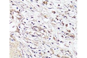 Immunohistochemistry of paraffin-embedded Human stomach cancer using VEGF Monoclonal Antibody at dilution of 1:150 (40x lens). (VEGF 抗体)
