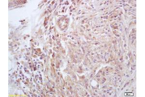 Formalin-fixed and paraffin embedded human liver carcinoma labeled with Anti-CKLF Polyclonal Antibody, Unconjugated (ABIN739650) at 1:200, followed by conjugation to the secondary antibody and DAB staining (CKLF 抗体  (AA 1-100))