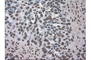 Immunohistochemical staining of paraffin-embedded Adenocarcinoma of colon tissue using anti-DHFRmouse monoclonal antibody. (Dihydrofolate Reductase 抗体)