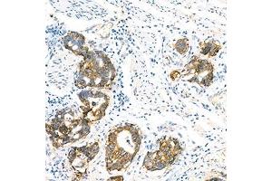 Immunohistochemistry analysis of paraffin-embedded human gastric cancer using LI Cadherin (ABIN7074493) at dilution of 1: 1500 (LI Cadherin 抗体)