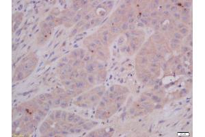 Formalin-fixed and paraffin embedded human laryngocarcinoma tissue labeled with Anti-COMMD4 Polyclonal Antibody, Unconjugated 1:400 followed by conjugation to the secondary antibody and DAB staining. (COMMD4 抗体  (AA 1-100))
