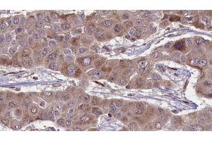 ABIN6269021 at 1/100 staining Human liver cancer tissue by IHC-P. (FSHR 抗体  (Internal Region))