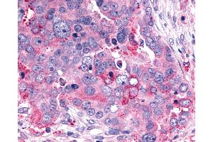 Anti-GHRHR antibody IHC of human Ovary, Carcinoma. (GHRHR 抗体  (C-Term))