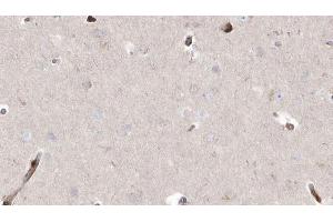 ABIN6272909 at 1/100 staining Human brain cancer tissue by IHC-P. (ABHD5 抗体  (Internal Region))