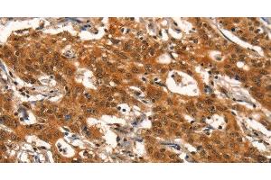 Immunohistochemistry of paraffin-embedded Human gasrtic cancer tissue using DEAF1 Polyclonal Antibody at dilution 1:40 (DEAF1 抗体)