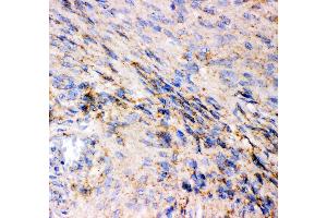 Anti- GRIA1 antibody, IHC(P) IHC(P): Human Meningeoma Tissue (Glutamate Receptor 1 抗体  (AA 19-360))