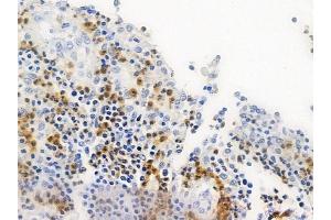 ABIN6258532 and ABIN6274803 at 1/100 staining human colon carcinoma by IHC-P. (ACBD6 抗体  (Internal Region))