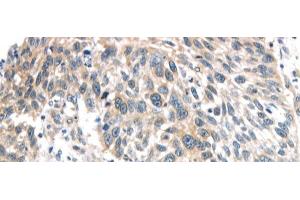 Immunohistochemistry of paraffin-embedded Human lung cancer using IQGAP2 Polyclonal Antibody at dilution of 1/40 (IQGAP2 抗体)