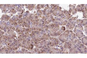 ABIN6273292 at 1/100 staining Human pancreas cancer tissue by IHC-P. (PDHX 抗体)