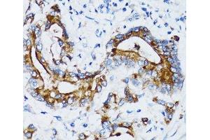 Immunohistochemistry of paraffin-embedded Human colon carcinoma using MMP7 Polyclonal Antibody at dilution of 1:100 (40x lens). (MMP7 抗体)