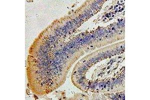 Immunohistochemical analysis of Alpha-crystallin A staining in human colon cancer formalin fixed paraffin embedded tissue section. (CRYAA 抗体)