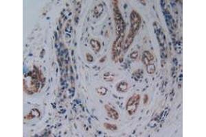IHC-P analysis of Human Breast Cancer Tissue, with DAB staining. (PAK1 抗体  (AA 252-501))