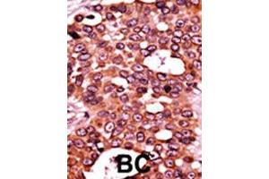 Formalin-fixed and paraffin-embedded human cancer tissue reacted with the primary antibody, which was peroxidase-conjugated to the secondary antibody, followed by AEC staining. (CDC6 抗体  (pSer54))