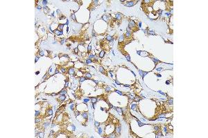 Immunohistochemistry of paraffin-embedded human breast cancer using RARα antibody (ABIN7269946) at dilution of 1:100 (40x lens).