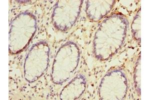 Immunohistochemistry of paraffin-embedded human colon cancer using ABIN7144679 at dilution of 1:100 (NAT2 抗体  (AA 1-290))