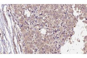 ABIN6266584 at 1/100 staining Human Melanoma tissue by IHC-P. (MLANA 抗体  (Internal Region))