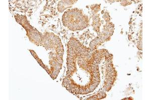 IHC-P Image Immunohistochemical analysis of paraffin-embedded human gastric cancer, using 39331, antibody at 1:100 dilution. (Septin 7 抗体)