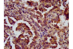 IHC image of ABIN7151021 diluted at 1:600 and staining in paraffin-embedded human lung cancer performed on a Leica BondTM system. (FANCL 抗体  (AA 138-248))