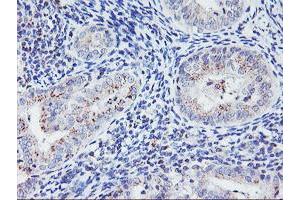 Immunohistochemical staining of paraffin-embedded Adenocarcinoma of Human endometrium tissue using anti-HES1 mouse monoclonal antibody. (HES1 抗体)