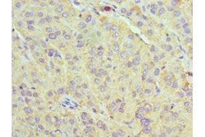 Immunohistochemistry of paraffin-embedded human liver cancer using ABIN7170632 at dilution of 1:100 (U2AF1 抗体  (AA 1-240))