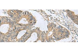 Immunohistochemistry of paraffin-embedded Human colorectal cancer tissue using CXCR5 Polyclonal Antibody at dilution of 1:80(x200) (CXCR5 抗体)
