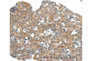 Immunohistochemistry of Human breast cancer using SCN11A Polyclonal Antibody at dilution of 1:40