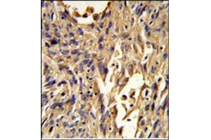 Immunohistochemistry analysis in Formalin Fixed, Paraffin Embedded Human lung carcinoma using S100A10 Antibody (Center) followed by peroxidase conjugation of the secondary antibody and DAB staining. (S100A10 抗体  (Middle Region))