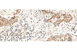 Immunohistochemistry of paraffin-embedded Human esophagus cancer tissue using HOXD9 Polyclonal Antibody at dilution of 1:30(x200) (HOXD9 抗体)