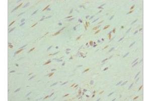 Immunohistochemistry of paraffin-embedded human colon cancer using ABIN7168762 at dilution of 1:100 (SEPHS1 抗体  (AA 1-392))