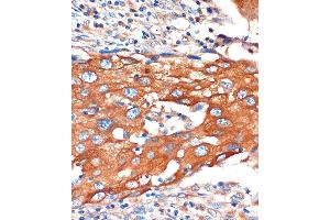 Immunohistochemistry of paraffin-embedded Human breast cancer using IQG Rabbit pAb (ABIN7268022) at dilution of 1:100 (40x lens). (IQGAP2 抗体  (AA 1330-1440))