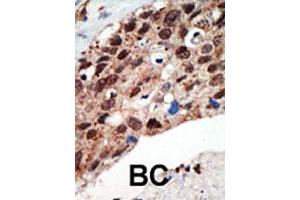 Formalin-fixed and paraffin-embedded human cancer tissue reacted with the SETD7 polyclonal antibody  , which was peroxidase-conjugated to the secondary antibody, followed by DAB staining. (SETD7 抗体  (Internal Region))
