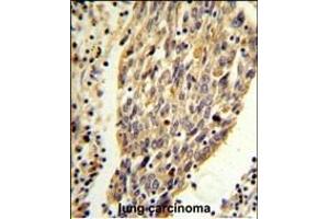 PKM2 (N-term ) Antibody (ABIN653018 and ABIN2842641) IHC analysis in formalin fixed and paraffin embedded human lung carcinoma followed by peroxidase conjugation of the secondary antibody and DAB staining. (PKM2 抗体  (N-Term))