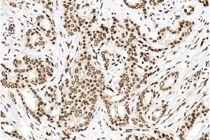 Immunohistochemical analysis of paraffin-embedded human breast cancer tissue using (ABIN1881702 and ABIN2838736). (PTBP1 抗体  (N-Term))