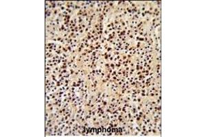Formalin-fixed and paraffin-embedded human lymphoma reacted with LCK Antibody (C-term), which was peroxidase-conjugated to the secondary antibody, followed by DAB staining. (LCK 抗体  (C-Term))