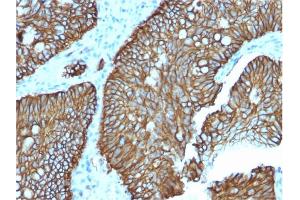 Formalin-fixed, paraffin-embedded human Colon stained with Cadherin 17 / CDH17 Mouse Monoclonal Antibody (CDH17/2618). (LI Cadherin 抗体  (AA 242-418))
