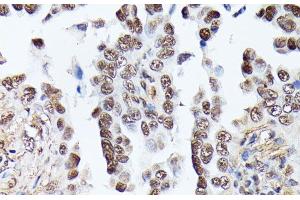 Immunohistochemistry of paraffin-embedded Human lung cancer using TPI1 Polyclonal Antibody at dilution of 1:100 (40x lens). (TPI1 抗体)